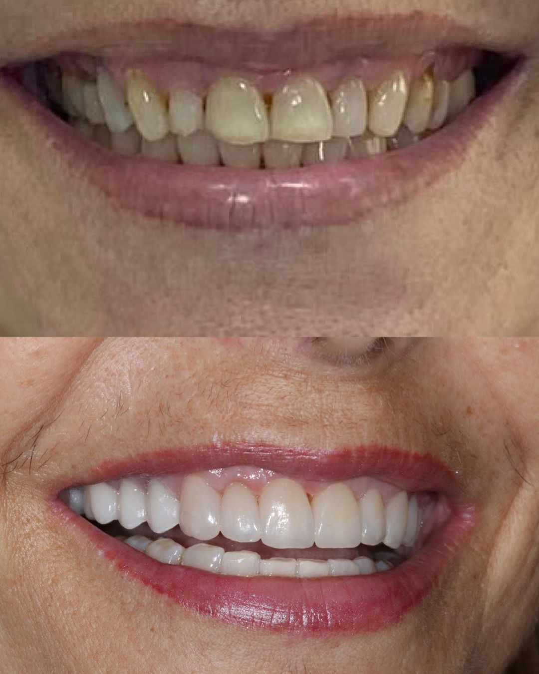 Antes e depois do sorriso de Rose Miriam (Reprodução/Instagram)